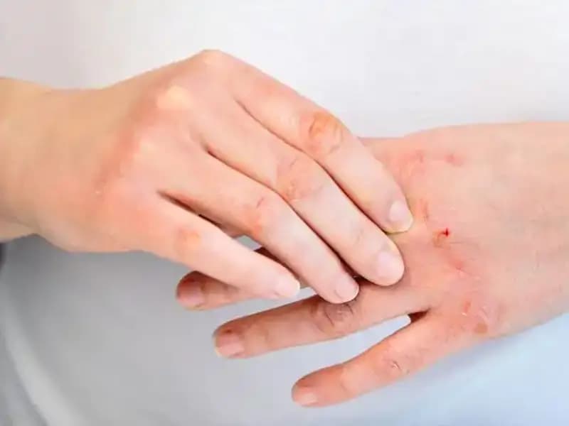 Yeterli Protein Tüketmediğinizi Gösteren 6 Belirgin İşaret