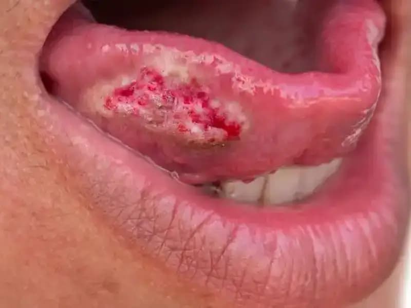 36 Yaşındaki Kadının Migren Ağrısı, Kanser Teşhisiyle Sonuçlandı