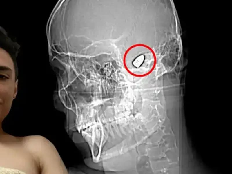 Kafasında Patlayıcıyla Gezen Adamın Hikayesi Duşunuzu Aşacak
