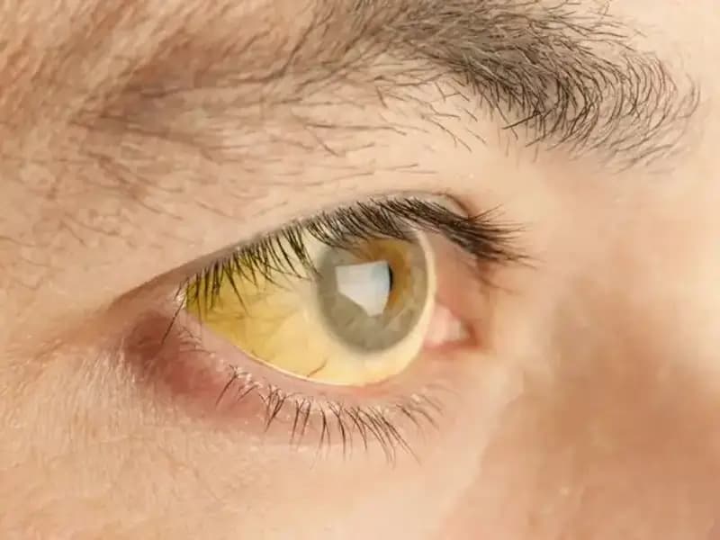 Gözlerinizi Kontrol Edin: Karaciğer Sağlığınız Tehlikede Olabilir